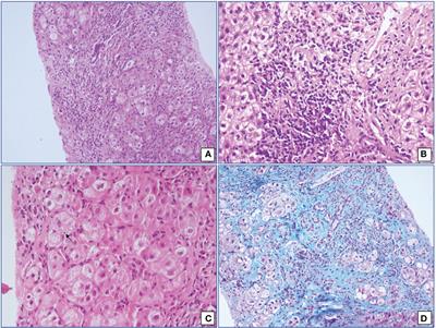 HLA and Non-HLA gene polymorphisms in autoimmune hepatitis patients of North Indian adults
